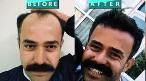 HairextreM & Haydar Aslan Saç Ekimi - Fotoğraf 1