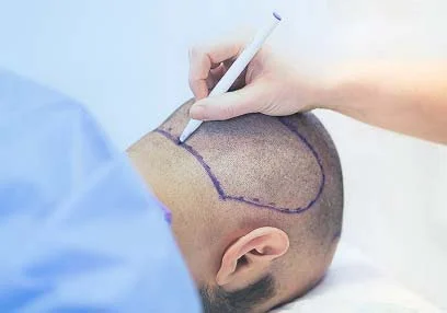 Hairey Saç Ekim Merkezi - Fotoğraf 1