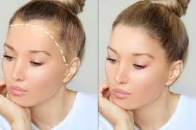 For Legend Hair Transplant - Fotoğraf 1