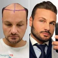Saç ekimi Türkiye