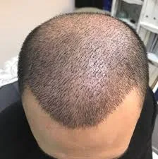 En İyi Çiğli Saç Ekim Merkezleri - 02 - Puan.com